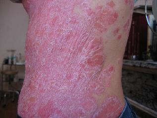 Dermatite pieghe cutanee