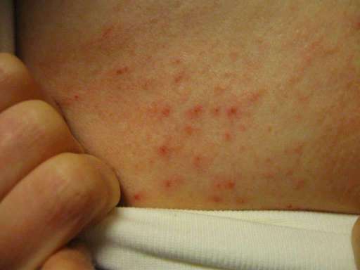 Dermatite Erpetiforme: rash cutaneo