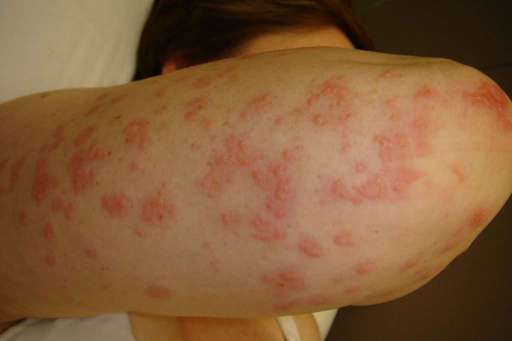 Dermatite Erpetiforme: rash cutaneo