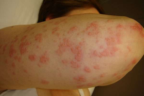 Dermatite Erpetiforme: sintomi, diagnosi e terapia