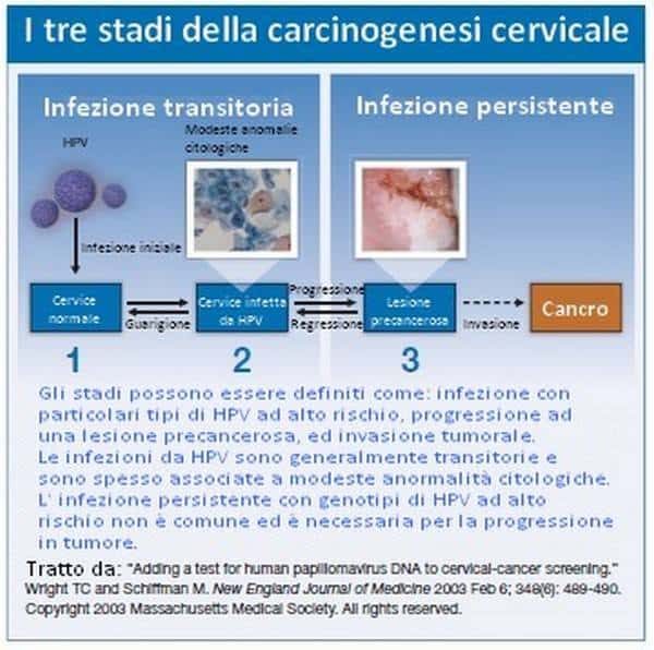 Papilloma virus positivo senza lesioni. Papilloma virus positivo senza lesioni