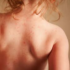 Orticaria: classificazione, diagnosi e terapia