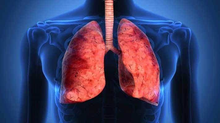 Polmoniti interstiziali o malattie interstiziali polmonari