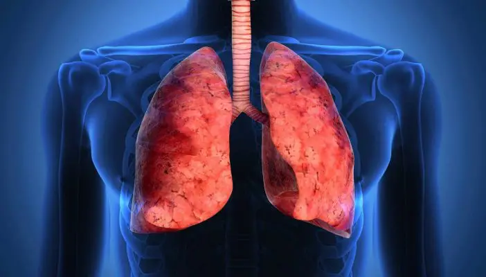 Polmoniti interstiziali o malattie interstiziali polmonari
