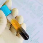 terapia anticoagulante orale
