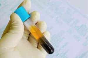 terapia anticoagulante orale