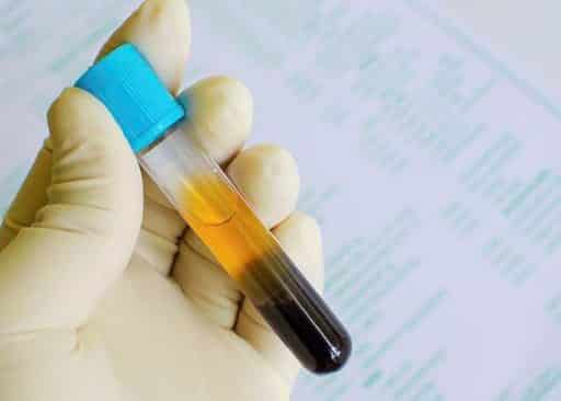 terapia anticoagulante orale