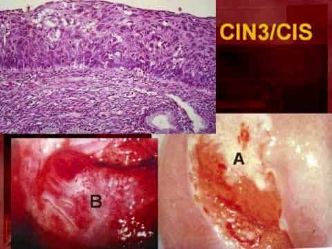 Terapia delle CIN (Neoplasie Cervicali Intraepiteliali)