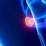 tumore della prostata