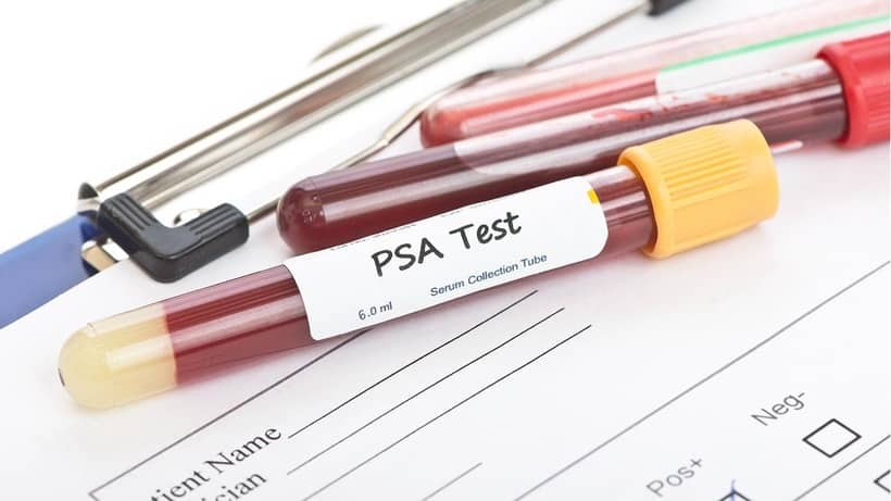 Dutasteride e Finasteride: correzione PSA