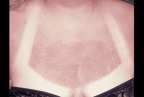Farmaci e luce: eritema solare