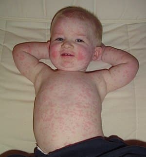megaloeritema infettivo o quinta malattia: esantema