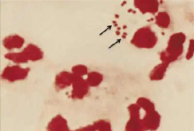 Meningococco (Neisseria meningitidis): colorazione di Gram