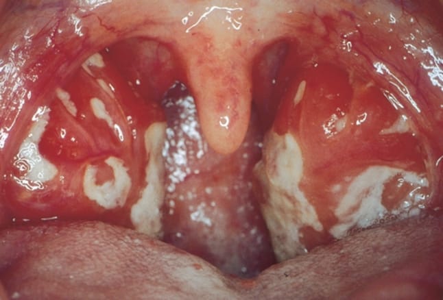 mononucleosi infettiva: faringite