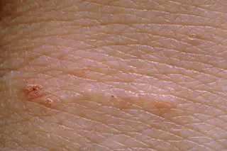 scabbia: il cunicolo