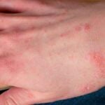 Scabbia: tipica dermatite