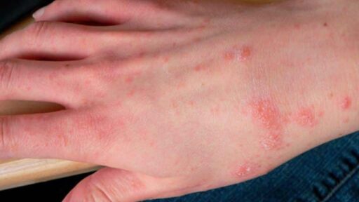 Scabbia: tipica dermatite