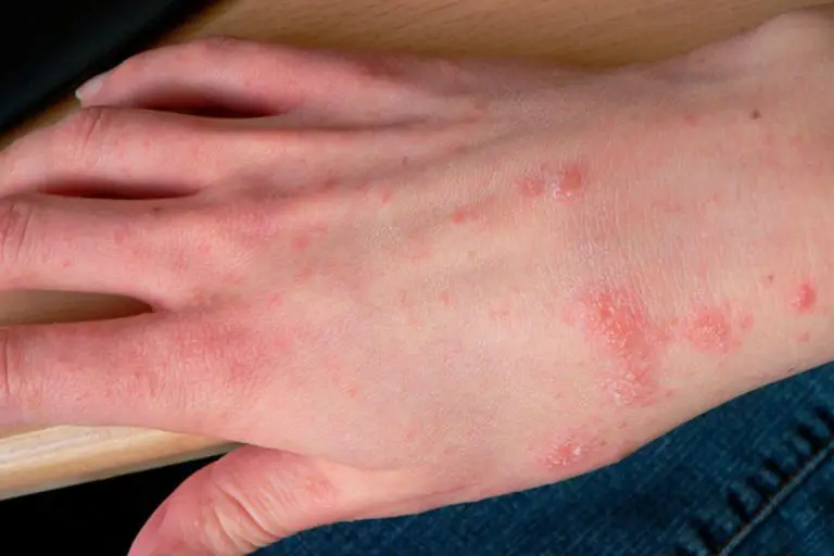 Scabbia: tipica dermatite