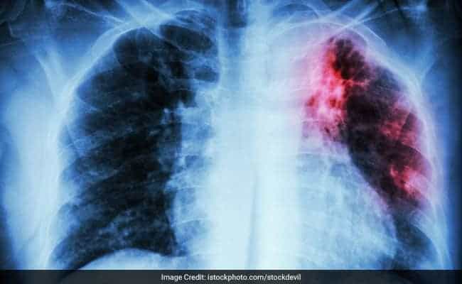 Tubercolosi polmonare: aspetto radiologico