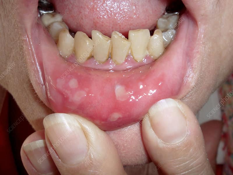 Mani Piedi Bocca: afte nella mucosa orale