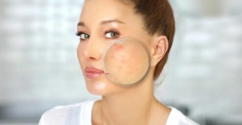 Cosa fa peggiorare l’acne?