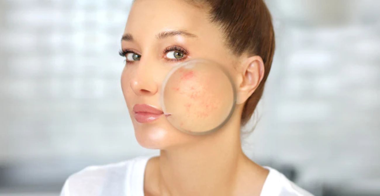 Cosa fa peggiorare l’acne?