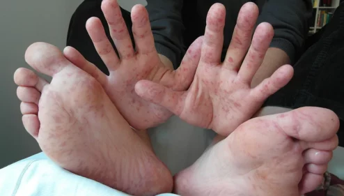 Come si cura la mani piedi bocca?