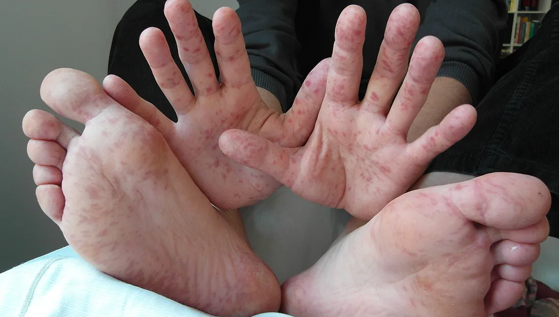 Come si cura la mani piedi bocca?