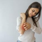 orticaria
