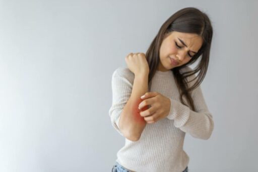 orticaria