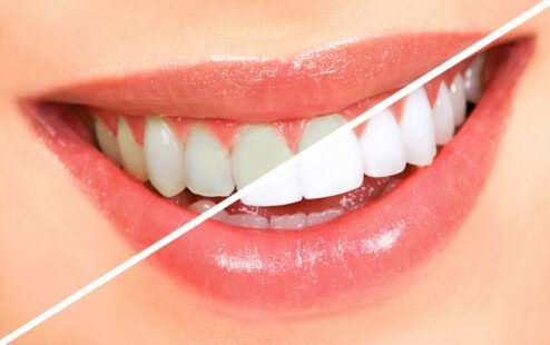Che pasta usano i dentisti per lo sbiancamento denti?