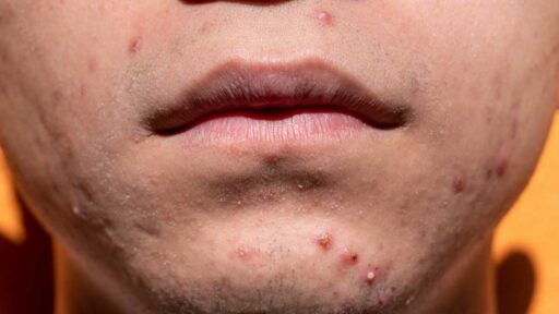 Acne_ bolle intorno alla bocca
