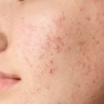 Acne_ bolle sulla guancia di ragazza giovane