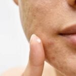 Acne_ cicatrici sul viso