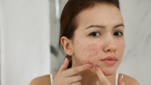 Acnezaic: effetti collaterali e controindicazioni