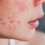 Acne_ guancia di una ragazza