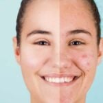 Acne_ pelle con e senza
