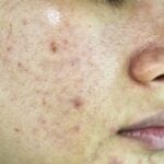 Acne_ segni sul viso