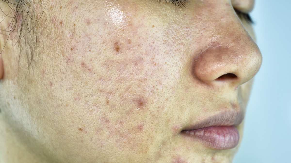 Acne_ segni sul viso