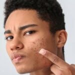 Acne_ viso di ragazzo adolescente
