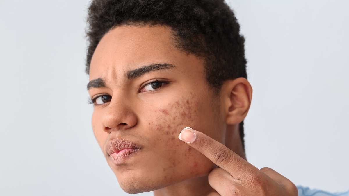 Acne_ viso di ragazzo adolescente