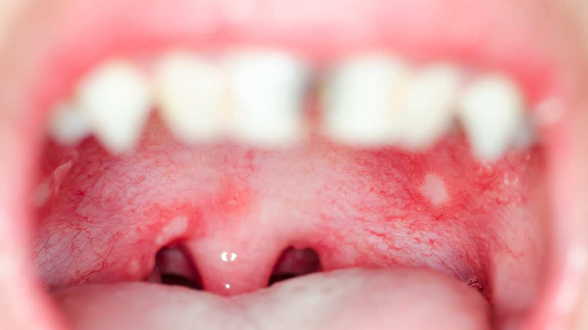 Che sciacqui fare per le afte in bocca?