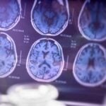 Esame diagnostico per Alzheimer