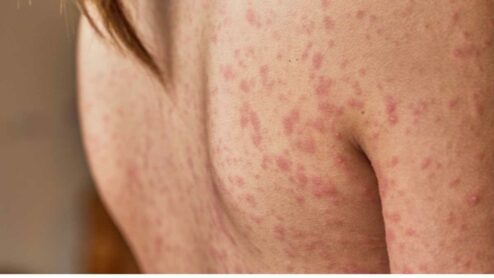 What does stage 1 of shingles look like?