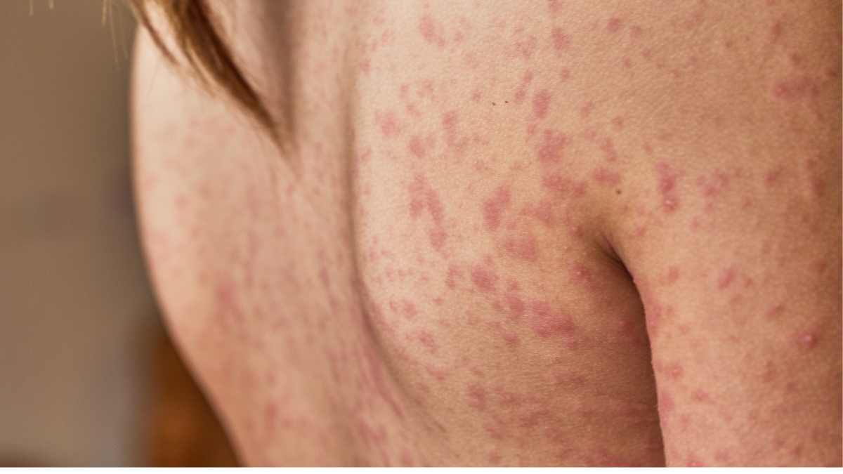 What does stage 1 of shingles look like?