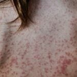 Allergic Rash on the skin