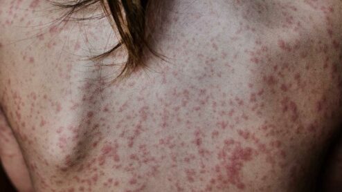What does bacterial meningitis rash look like?