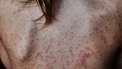 Allergic Rash on the skin
