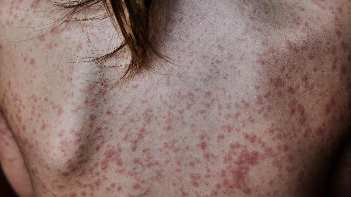 What does bacterial meningitis rash look like?