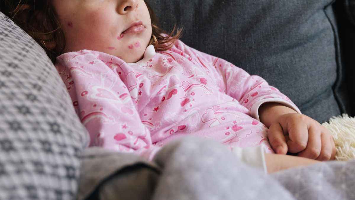 Bambina con macchie rosse del morbillo